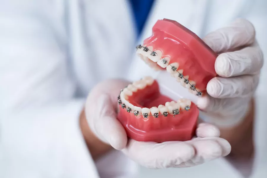 براکت پشت دندانی صاف کننده دندان