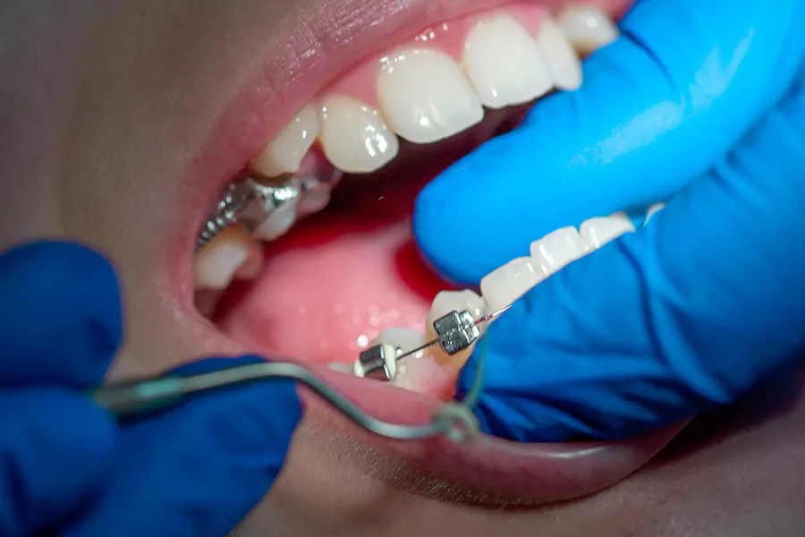 مراقبت‌های بعد از ارتودنسی