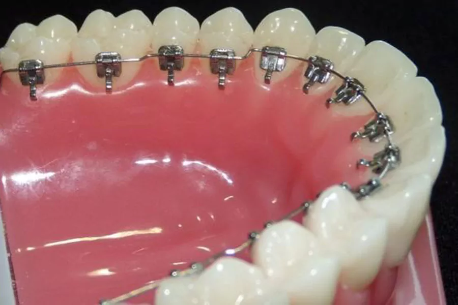 براکت‌های توربو یا پشت دندانی