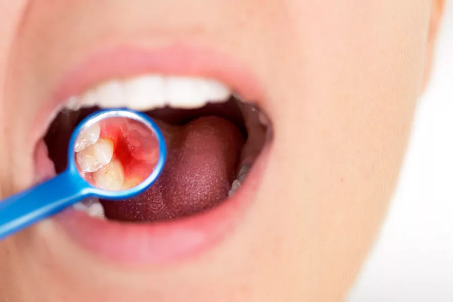 عوارض های لمینت دندان